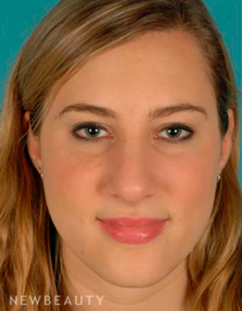 Dr. David Kim Rhinoplasty - After
