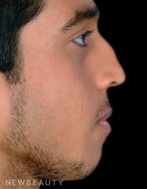 Dr. David Kim Rhinoplasty - Before