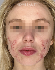 Dr. Anna Chacon – Acne Conglobata - 34277396 - Before