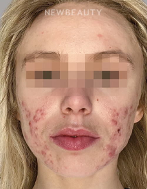 Dr. Anna Chacon – Acne Conglobata - 34277396 - Before
