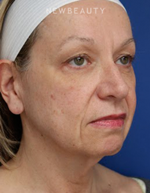 Dr. Joseph Russo - Rejuvenated Look (Face EBG) - Before