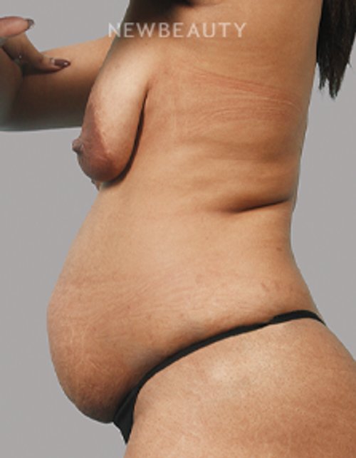 Dr. Keith Hanna - Mommy Makeover - 44725788 - Before