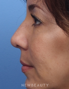 Dr. Kelly Bomer - Nonsurgical Rhinoplasty - After