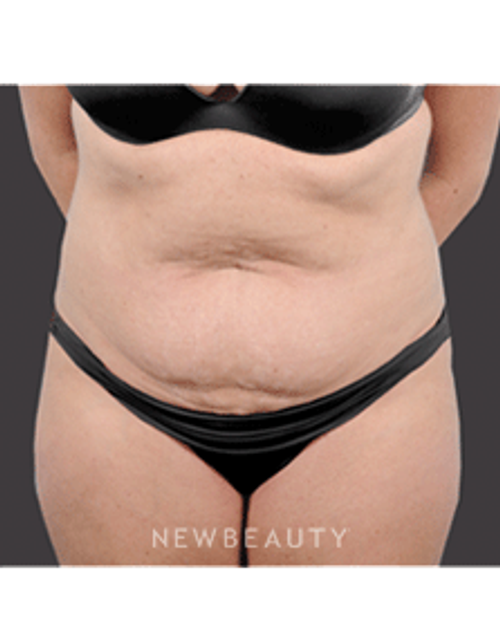 Dr. Bradley Bengtson Liposuction, Tummy Tuck - Before