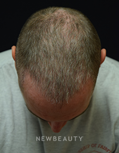 Dr. Jeffrey B. Wise - Hair Loss - After