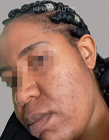 Dr. Anna Chacon - Acne - 34284242 - After