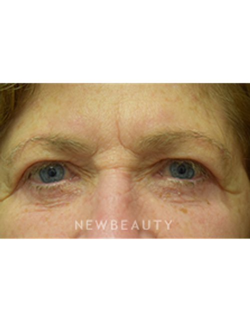 Dr. Jeffrey B. Wise - Eyelift - After