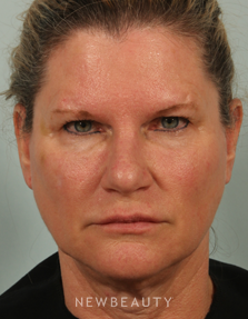 Dr. Kenneth Beer - Liquid Facelift - After