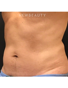 Dr. Janet Allenby - CoolSculpting - After