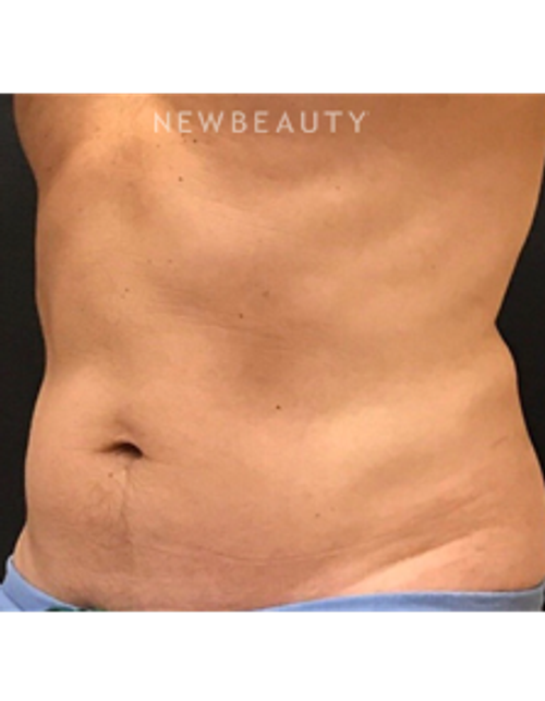 Dr. Janet Allenby - CoolSculpting - After