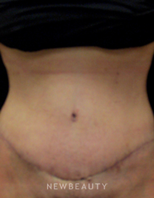 Dr. Mokhtar Asaadi Liposuction, Tummy Tuck - After