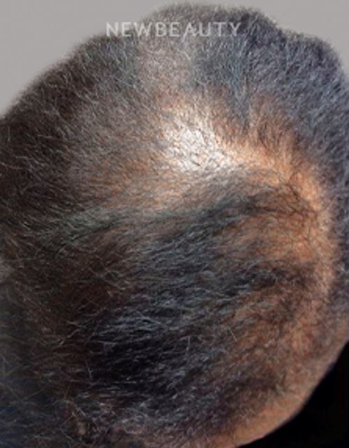 Dr. Valerie Calender - Hair Regrowth Treatment - 20905920 - After