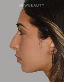 Dr. Anthony Bared - Rhinoplasty - 46164855 - Before