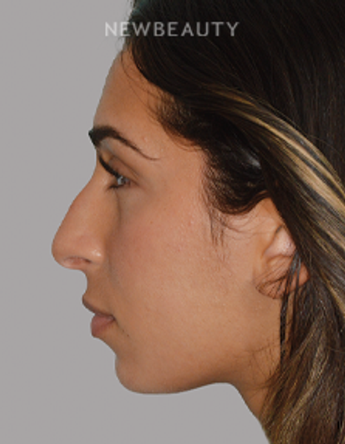 Dr. Anthony Bared - Rhinoplasty - 46164855 - Before