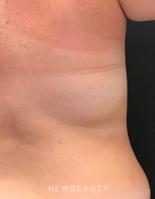 Dr. Janet Allenby - CoolSculpting - After