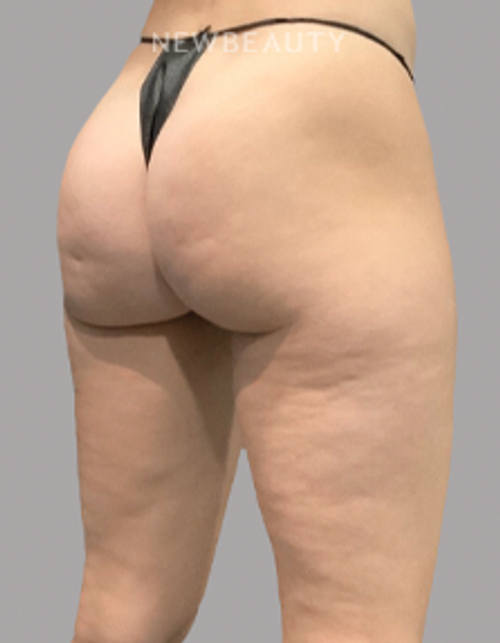 Dr. Janet Allenby -  Smooth Moves - 24004988 - Before