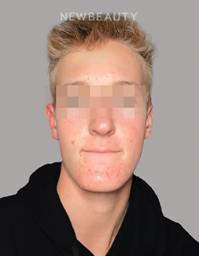 Dr. Anna Chacon - Acne - 34276787 - Before