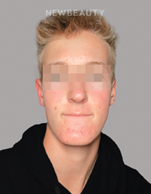 Dr. Anna Chacon - Acne - 34276787 - Before