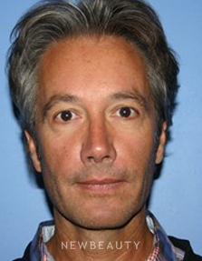 Dr. Kelly Bomer - Perlane - Before