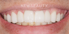 Dr. Nathan Hoffman - Teeth Whitening & Veneers - After