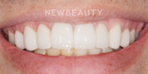 Dr. Nathan Hoffman - Teeth Whitening & Veneers - After