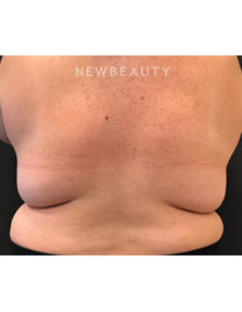 Dr. Janet Allenby - CoolSculpting - Before