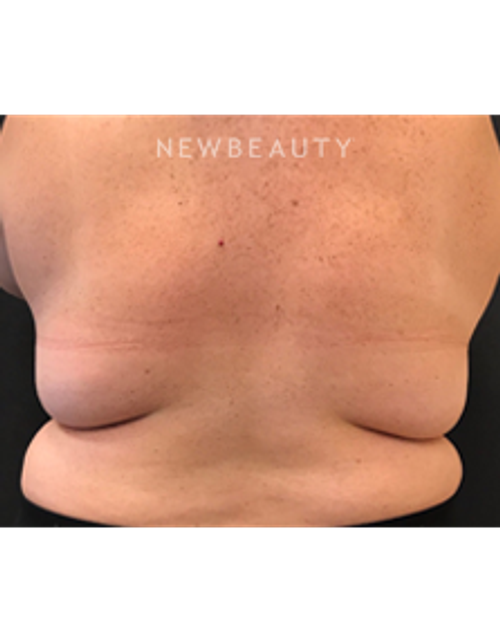 Dr. Janet Allenby - CoolSculpting - Before