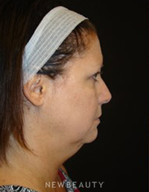 Dr. Joel Schlessinger - Kybella - Before
