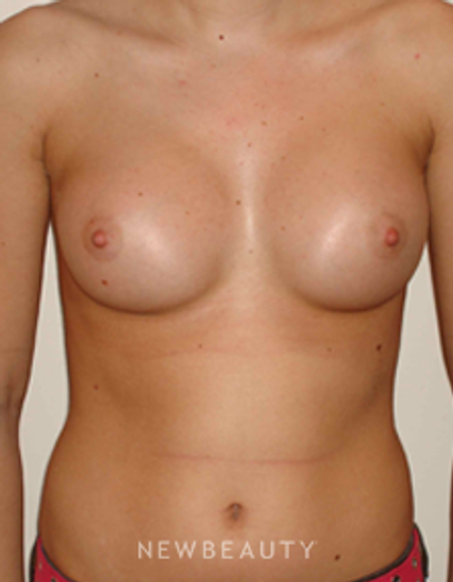 Dr. Michael Horn Breast Augmentation - After