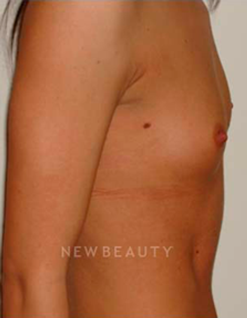 Dr. Michael Horn Silicone Breast Implants - Before