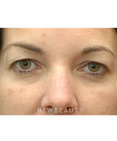 Dr. Jeffrey B. Wise - Eyelift - Before