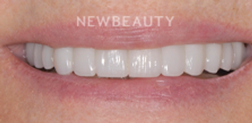 Dr. Salvator La Mastra - Smile Makeover -46107800 - After