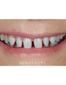 Dr. Guy Lewis Veneers, Gum Lift - Before