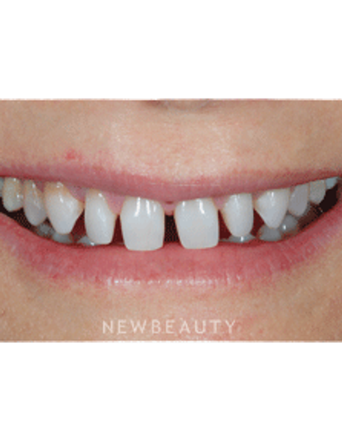 Dr. Guy Lewis Veneers, Gum Lift - Before