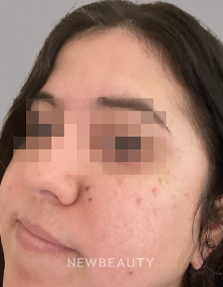 Dr. Anna Chacon - Seborrheic dermatitis - 34280035 - After