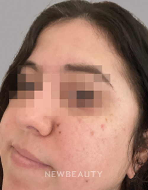 Dr. Anna Chacon - Seborrheic dermatitis - 34280035 - After