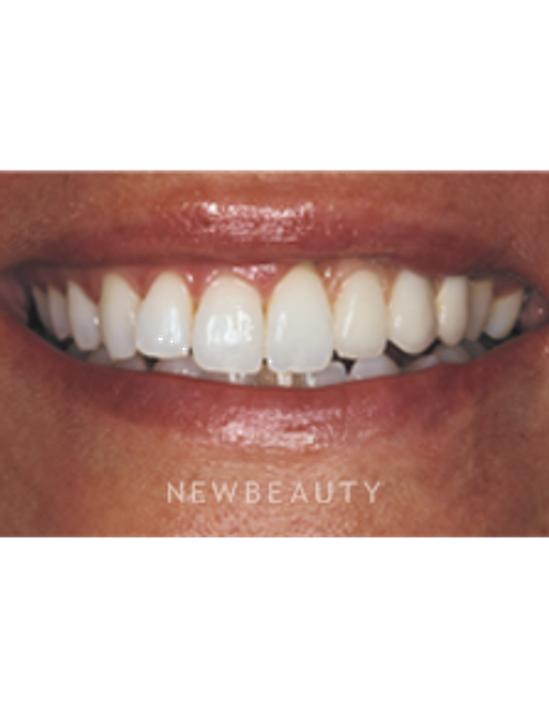 Dr. Neal Patel Crowns, Dental Implants, Smile Makeover - After