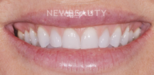 Dr. Salvator La Mastra- Smile Makeover -46106796 - Before