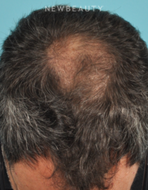 Dr. Bradley Bengtson - Hair Loss Treatment - Before