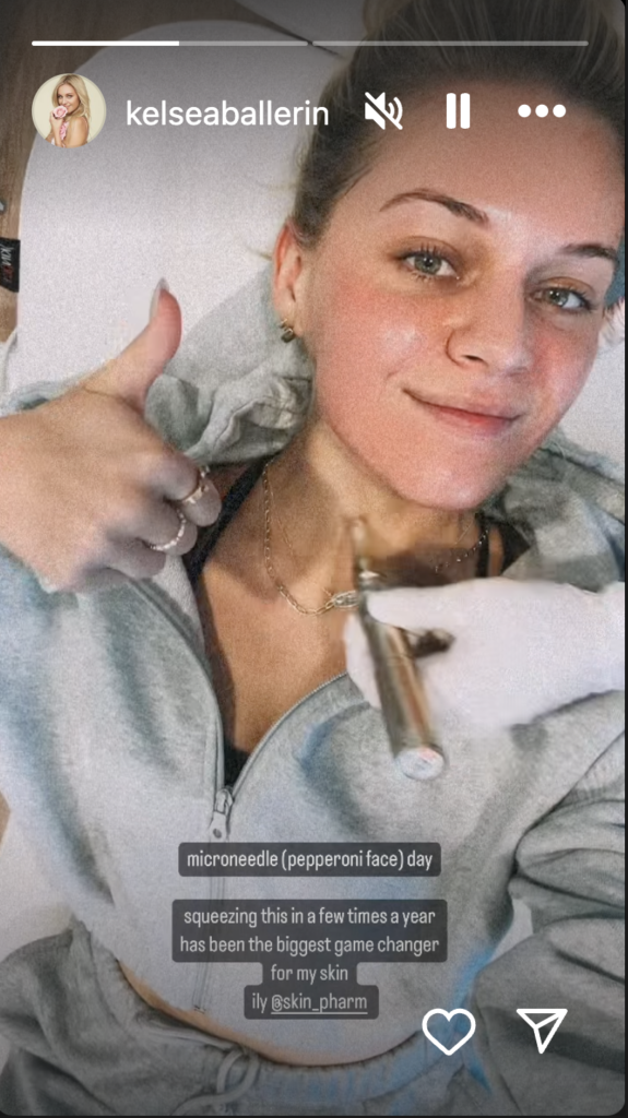 Kelsea Ballerini microneedling treatment