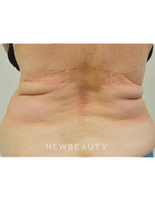 Dr. Julie Russak Fat Melters - After