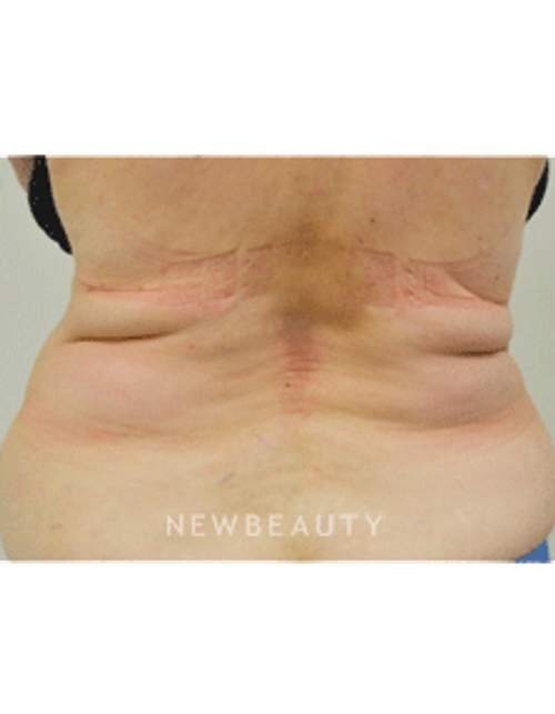 Dr. Julie Russak Fat Melters - After