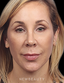 Dr. Kelly Bomer - Liquid Facelift - After