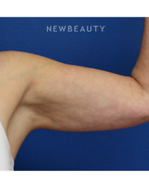 Dr. Joseph Russo - Arm Liposuction - After