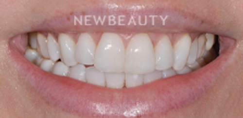 Dr. Salvator La Mastra – Smile Makeover – 46107351 - Before