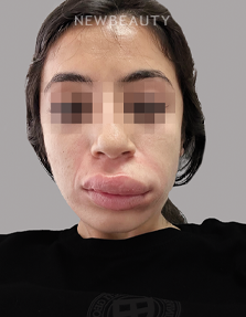 Dr. Anna Chacon - Angioedema - 34276863 - Before