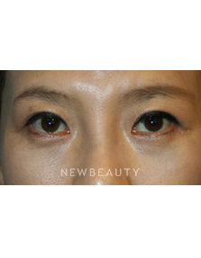 Dr. John Kang - Blepharoplasties & Rhinoplasty - After