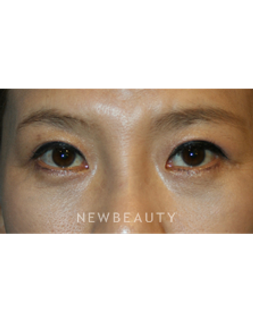 Dr. John Kang - Blepharoplasties & Rhinoplasty - After