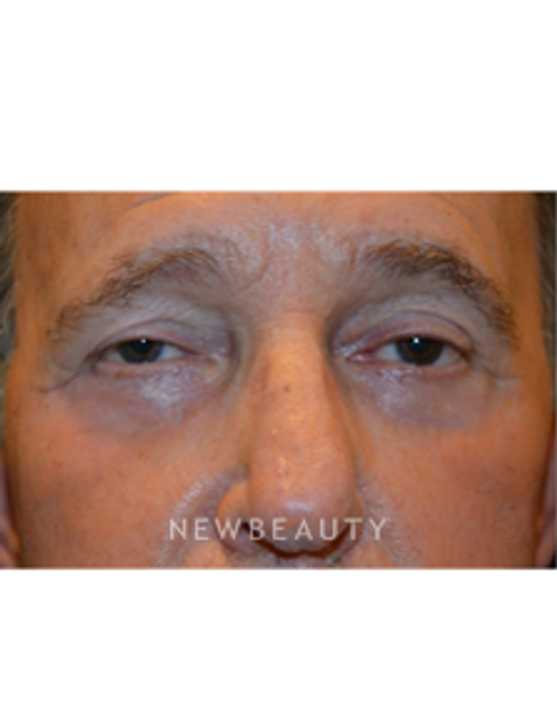 Dr. Aviva Preminger - Lower Blepharoplasty - After
