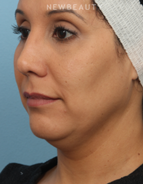 Dr. Kathleen Behr - Kybella & Botox - Before